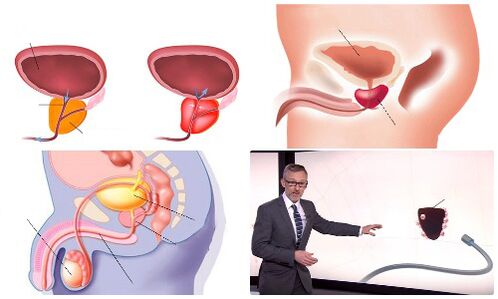 próstata sa e enferma